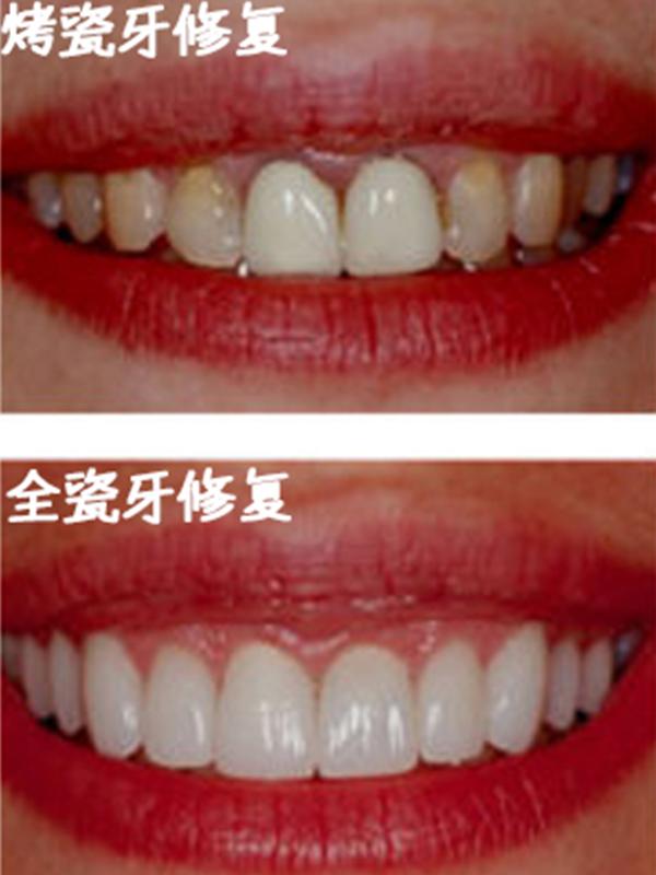 烤瓷牙修复